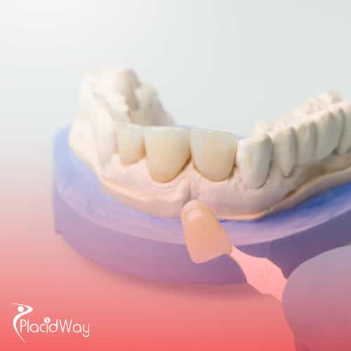 Veneers in Mexico: Transform Your Smile at a Fraction of California Prices